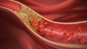 An image of a blood vessel depicting blood cells and cholesterol. The role of exercise to reduce cholesterol.