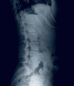 A scan image of the human spine in relation to the classification of low back pain